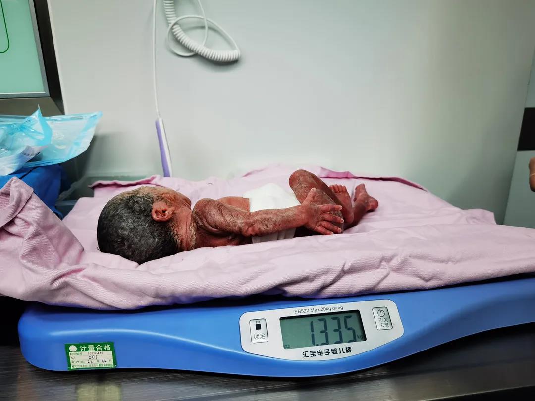 世界早产儿日活动2||娄星区人民医院早产儿特辑——我们长大了！_新生儿科